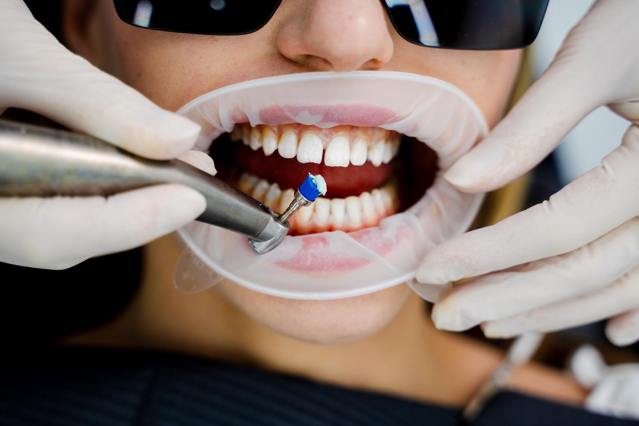 Professional Oral Hygiene: Prevention Based on Evidence-Based Dentistry