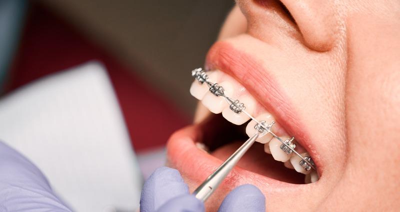 Orthodontic Treatment in Adults: Myths and Reality